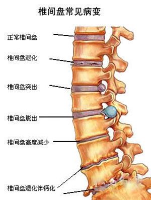 假腰突，即假性腰椎间盘突出症，是一种常见的脊柱疾病。它与真正的腰椎间盘突出症在症状和病因上有所不同。以下将详细解释假腰突的相关内容